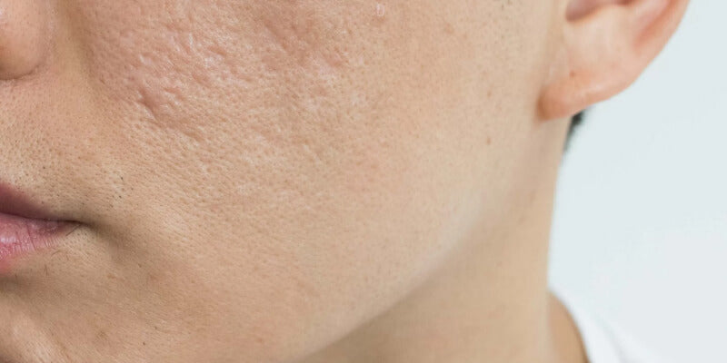 Best Acne Scar Creams: Find The Best One In Pakistan