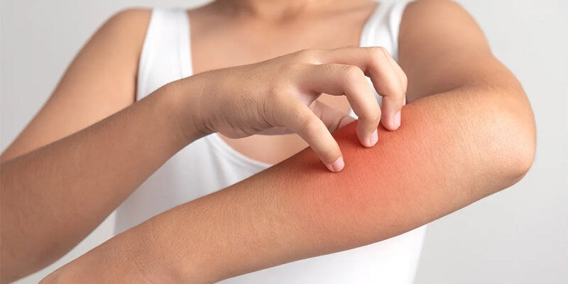 Tips To Treat Eczema: Natural Remedies & Medical Solutions