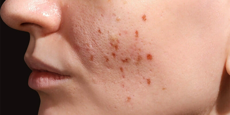 The Benefits of Vitamin C for Scar Healing and Skin Regeneration