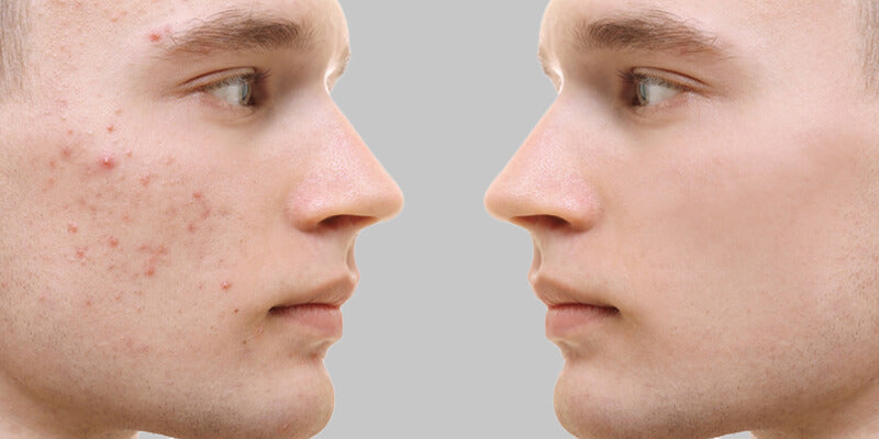 How To Get Rid Of Acne Scars? We've Got You Covered!