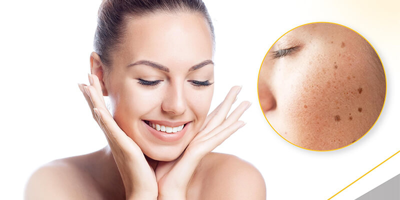 Effective Home Remedies for Hyperpigmentation: Regain Your Radiant Skin