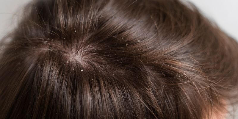 Natural Remedies for Dandruff, Treatments