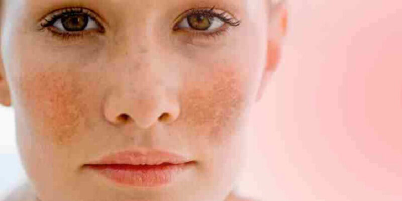 Hyperpigmentation solution: The solution for dark spots