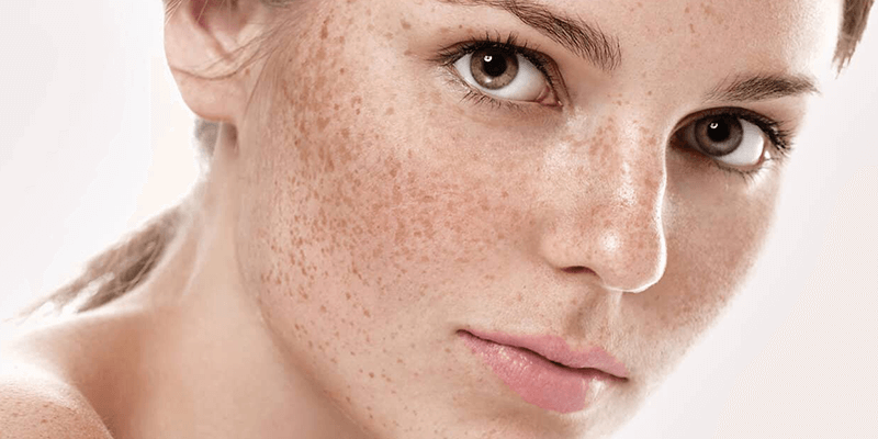 Hyperpigmentation causes: Types and Causes of dermal illness