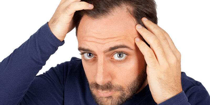 Hereditary hair loss is very common in male